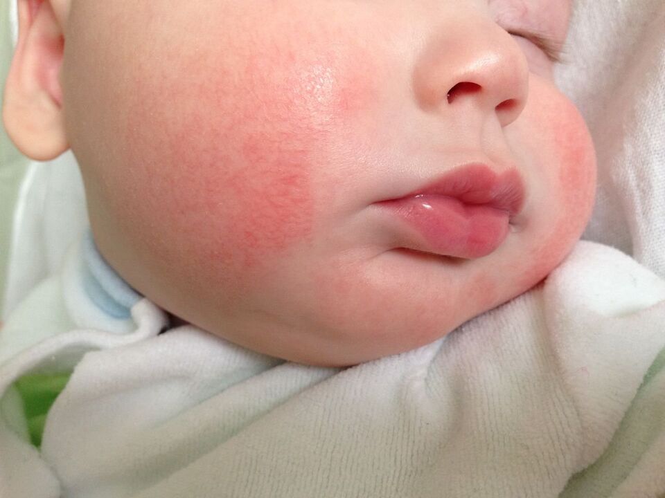 Ein Zeichen von Würmern bei einem Kind ist allergische Urtikaria. 